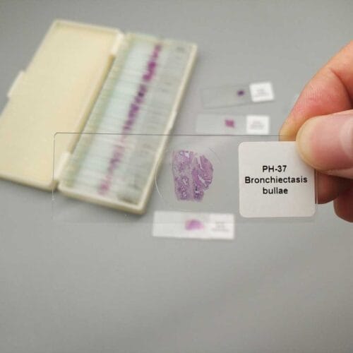 Bronchiectasis-bullae pathology slides
