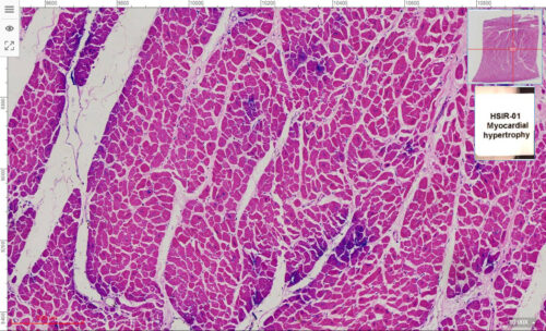 HSIR-01 Myocardial hypertrophy