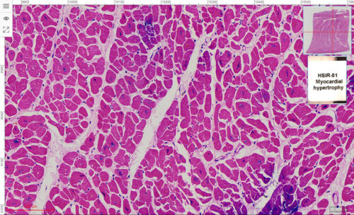 HSIR-01 Myocardial hypertrophy