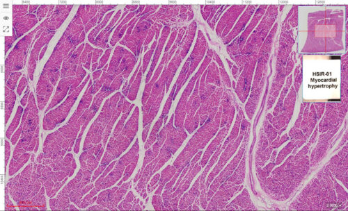 HSIR-01 Myocardial hypertrophy