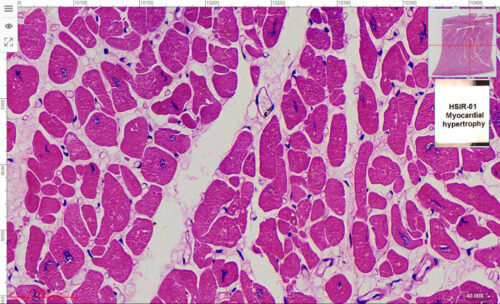 HSIR-01 Myocardial hypertrophy