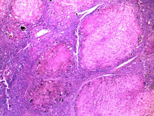 liver cirrhosis