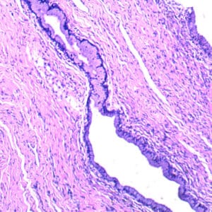 carcinoma in situ