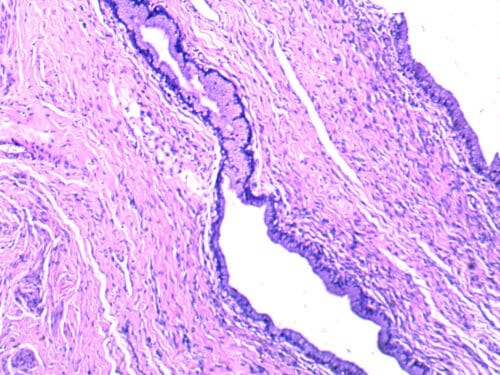 carcinoma in situ