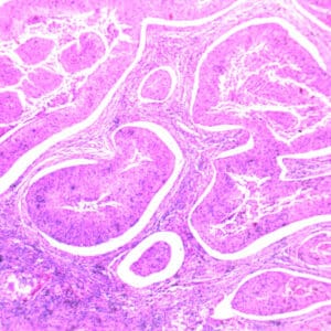 Cervical squamous carcinoma