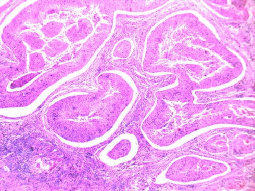 Cervical squamous carcinoma