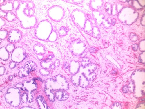 Poorly differentiated prostate cancer