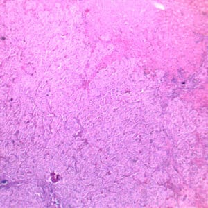 liver cancer hepatocarcinoma