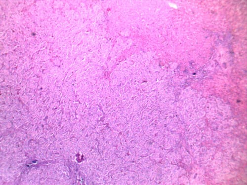 liver cancer hepatocarcinoma