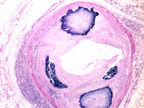 pathologic calcification