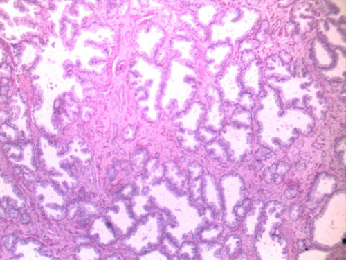 well differentiated prostate cancer