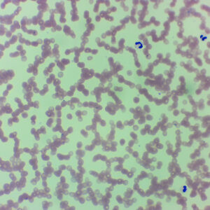 Plasmodium Vivax