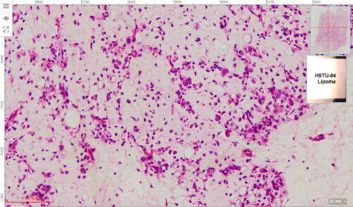 Lipoma, dermatopathology teaching slides, human pathology slides - Image 3