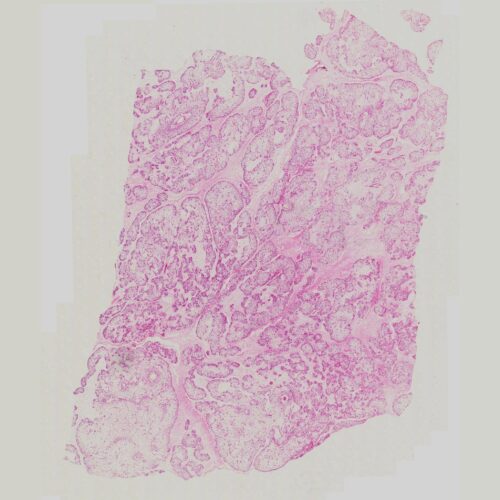 dermatopathology teaching slides Lipoma
