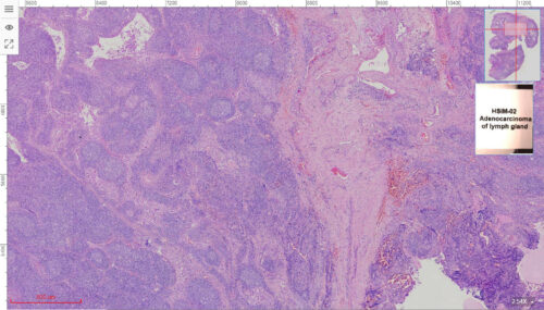 50pcs Cancer Pathology Slides, all about cancer - Image 2