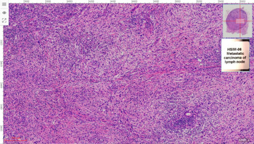 50pcs Cancer Pathology Slides, all about cancer - Image 3