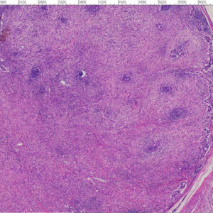 50pcs Cancer Pathology Slides, all about cancer