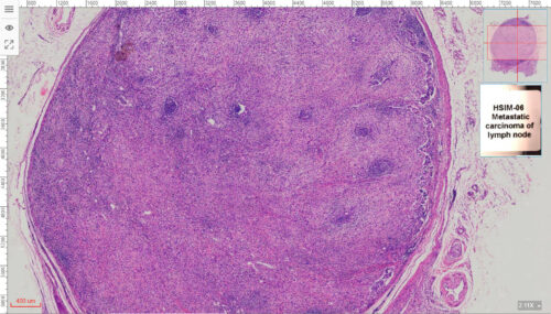 50pcs Cancer Pathology Slides, all about cancer