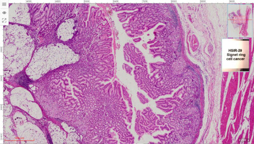 50pcs Cancer Pathology Slides, all about cancer - Image 4