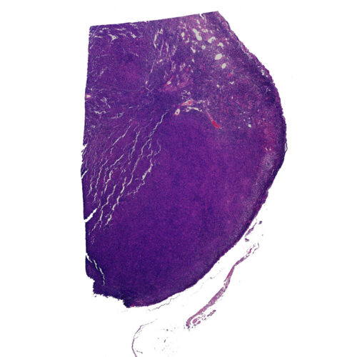 Hodgkin lymphoma Histopathology slides