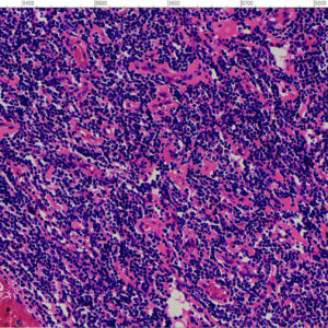 Hodgkin lymphoma View