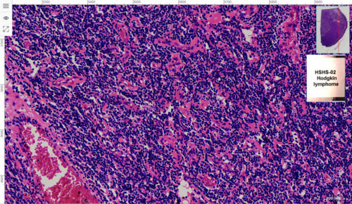 Hodgkin lymphoma View