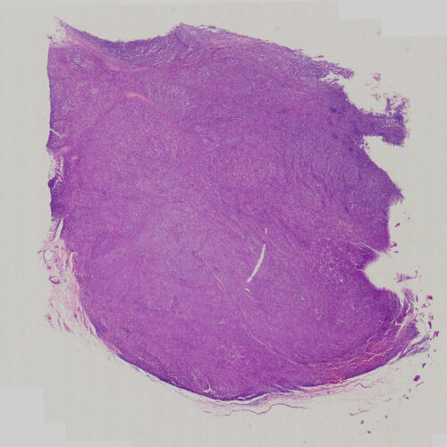 Non-Hodgkin lymphoma