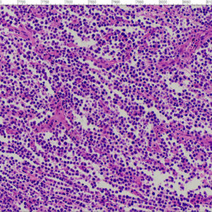 Non-Hodgkin lymphoma View