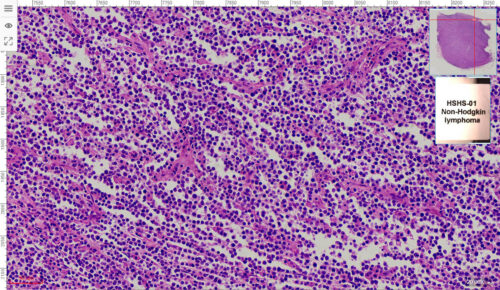 Non-Hodgkin lymphoma View