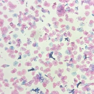 Cervical cancer screening tests, SurePath, PAP stain