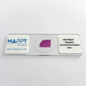 Hepatic Schistosomiasis